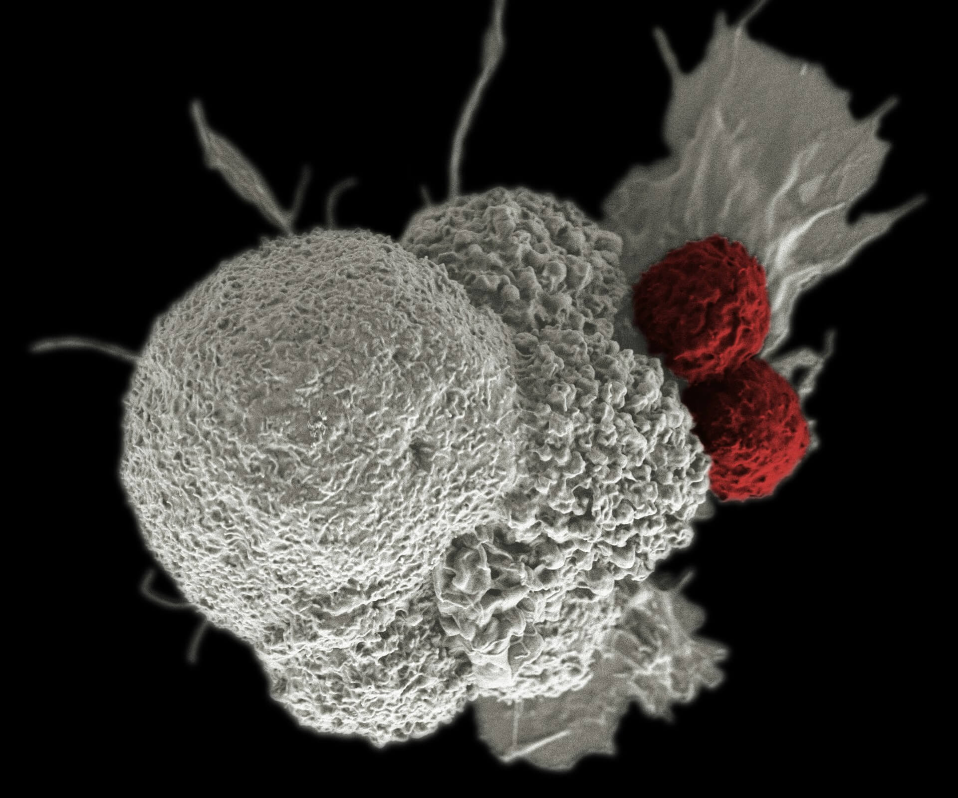 Tumor tissue samples after surgical removal
